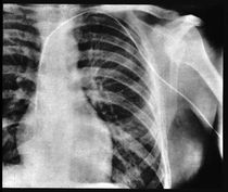 xray–chest–ribs.jpg
