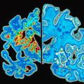 cancer–treatment–scan–brain.jpg