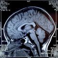 alzheimer–brain–scan.jpg