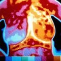 breast-cancer-thermogram.jpg