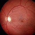 retina–blindness.jpg