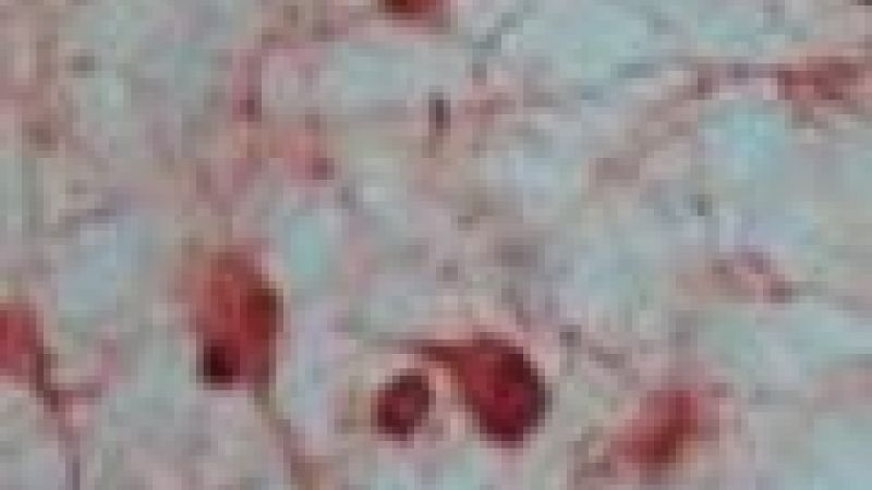 Mouse mimics another childhood brain cancer