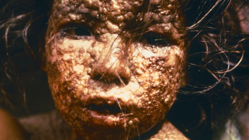 #WW Wednesday Web award - Smallpox Through Time