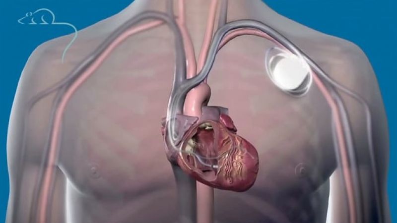 Pacemakers: a short history