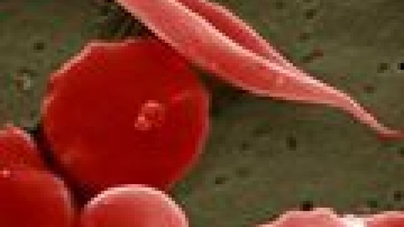 Gene therapy for sickle cell