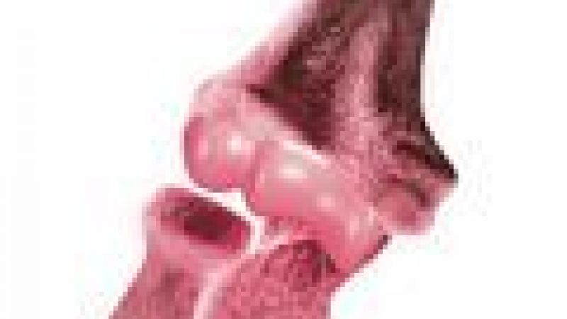 Faster repair for damaged bones